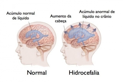 Hidrocefalia tem cura?