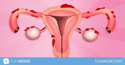 7 Dicas para viver melhor com Endometriose